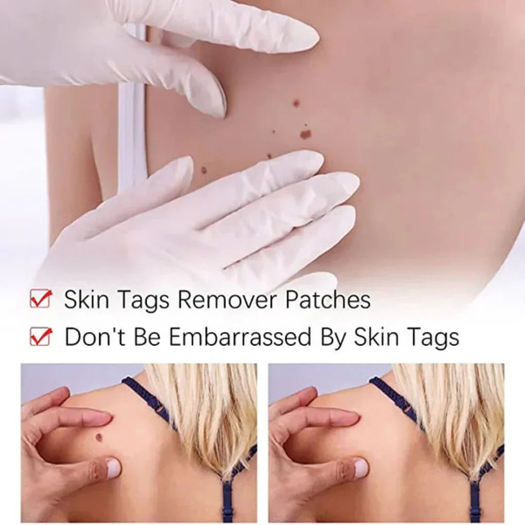 Davy | Natural Skin Tag & Mole Remover Pen