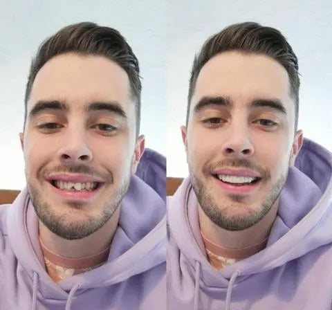 Davy | On Smile Veneers (Upper and Lower Jaw Included)