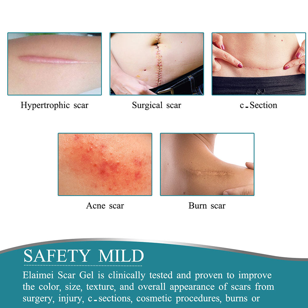 Davy | Silicone Scar Tape Roll