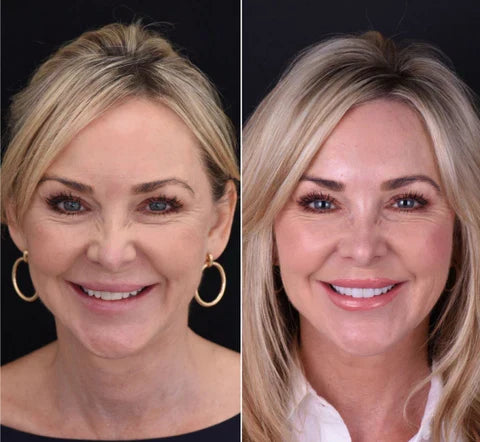 LumaGrin Instant Snap-On Veneers For Upper and Lower Teeth