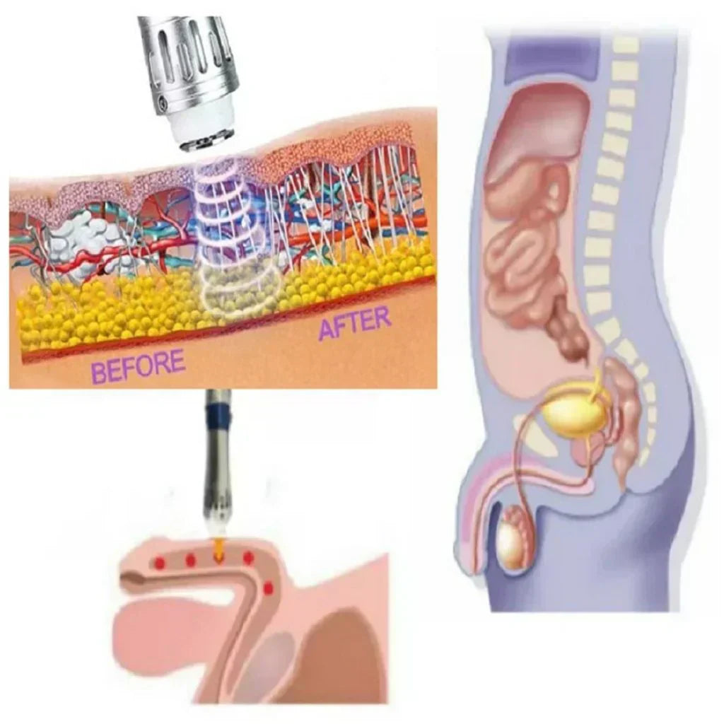 NovaPulse Portable Shockwave Therapy Device For Men With Case And Accessories