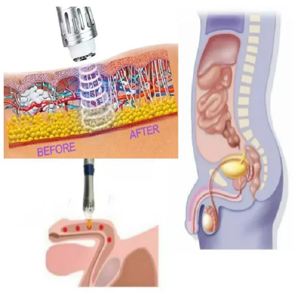 VitaPulse Portable ED Shockwave Therapy Device for Men